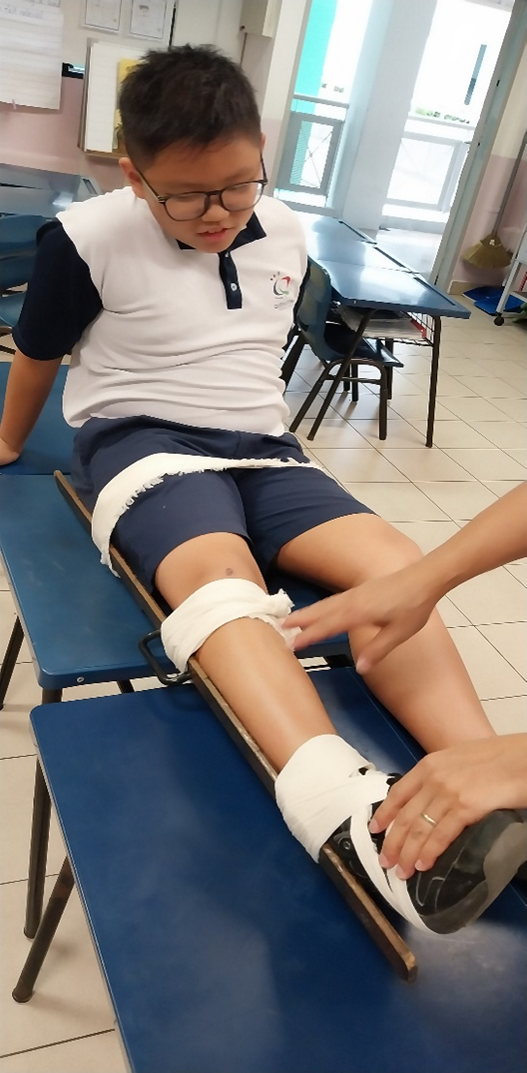Ouch! My leg is broken